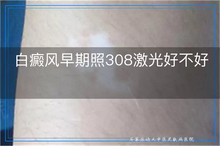 白癜风早期照308激光好不好