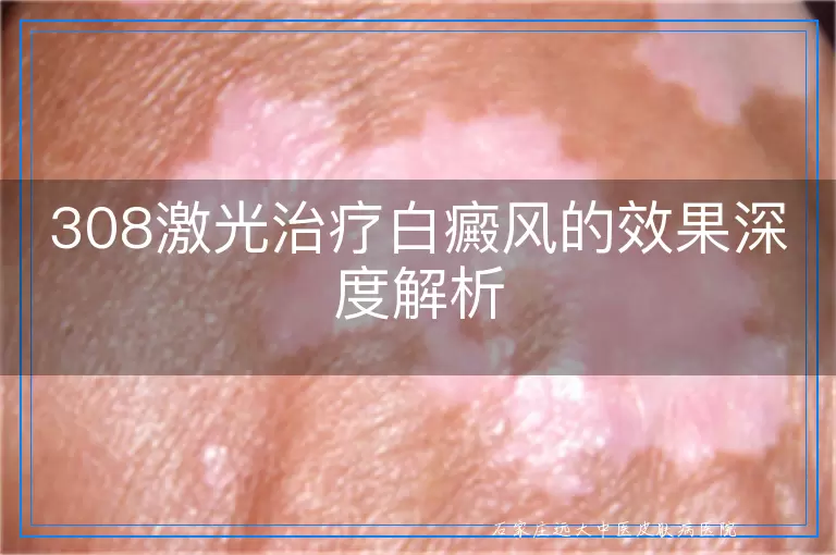 308激光治疗白癜风的效果深度解析