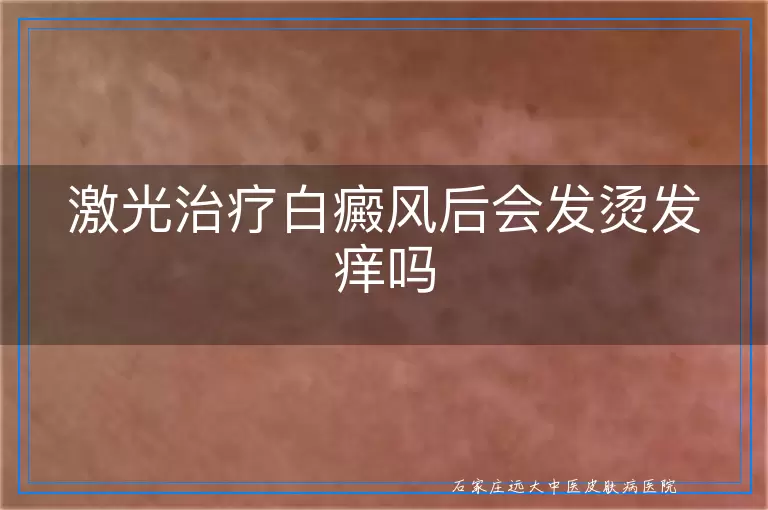 激光治疗白癜风后会发烫发痒吗