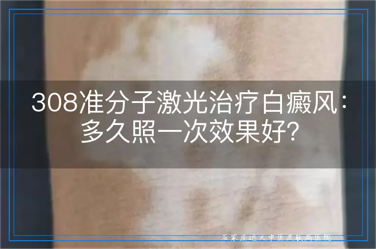308准分子激光治疗白癜风：多久照一次效果好？