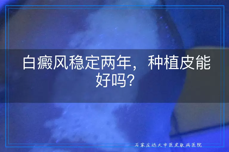 白癜风稳定两年，种植皮能好吗？