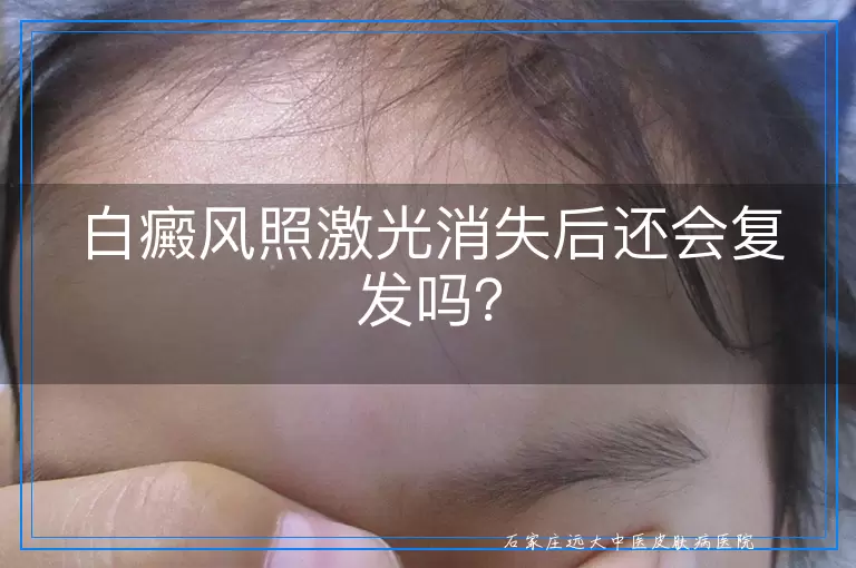 白癜风照激光消失后还会复发吗？