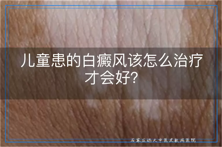 儿童患的白癜风该怎么治疗才会好？