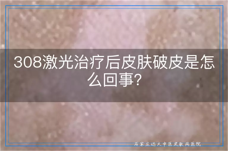 308激光治疗后皮肤破皮是怎么回事？