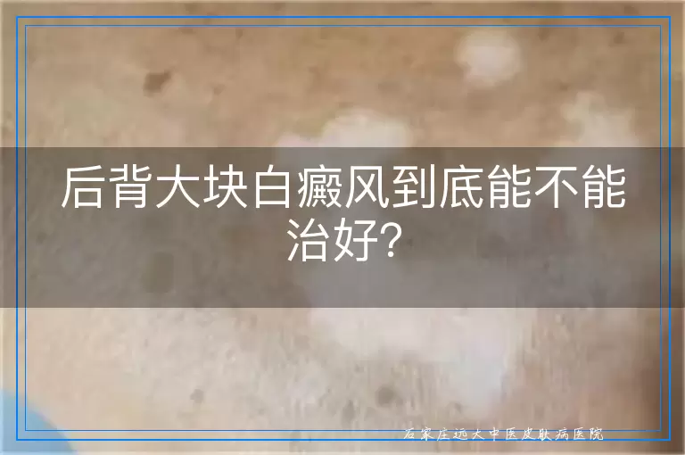 后背大块白癜风到底能不能治好？