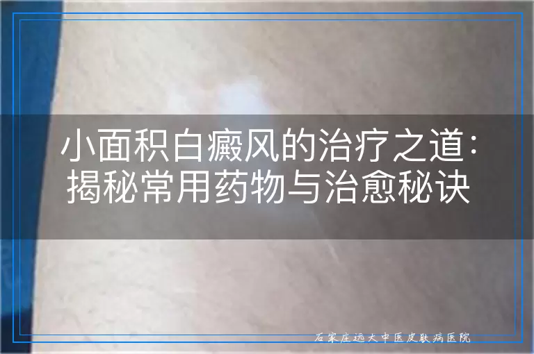 小面积白癜风的治疗之道：揭秘常用药物与治愈秘诀