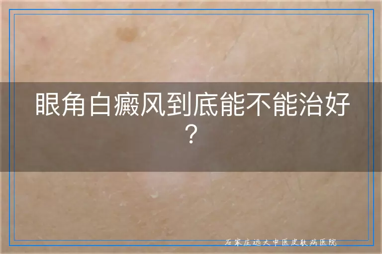 眼角白癜风到底能不能治好？