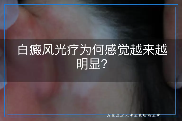 白癜风光疗为何感觉越来越明显？