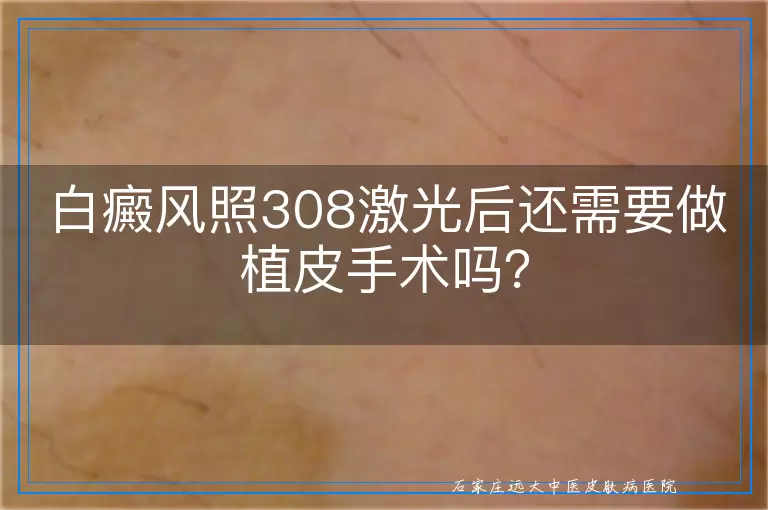 白癜风照308激光后还需要做植皮手术吗？