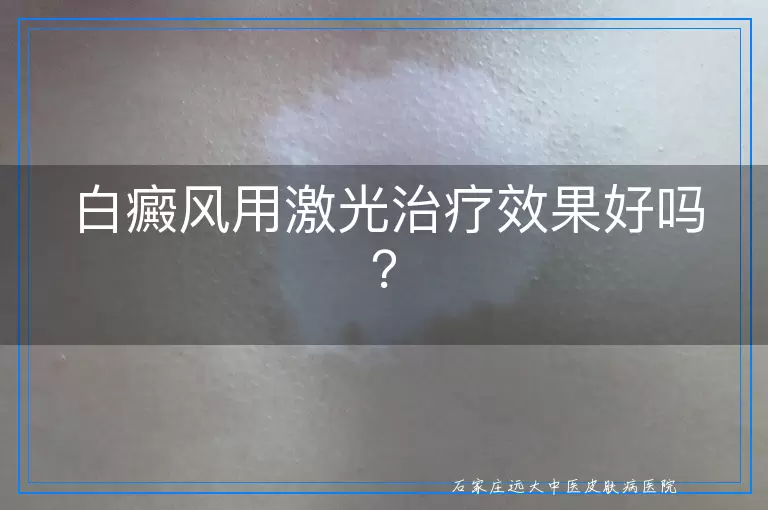 白癜风用激光治疗效果好吗？