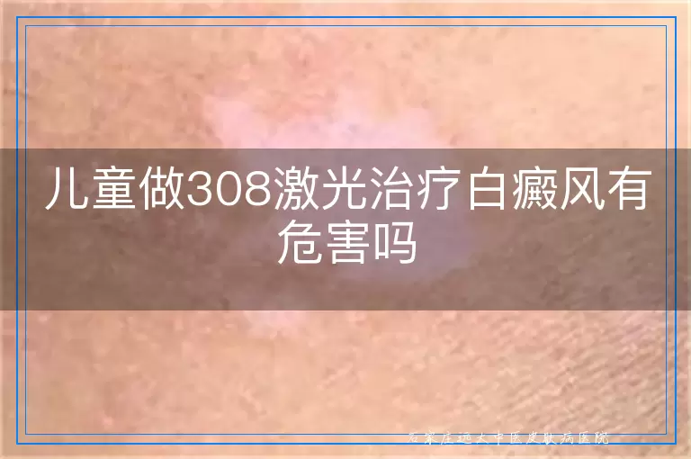 儿童做308激光治疗白癜风有危害吗