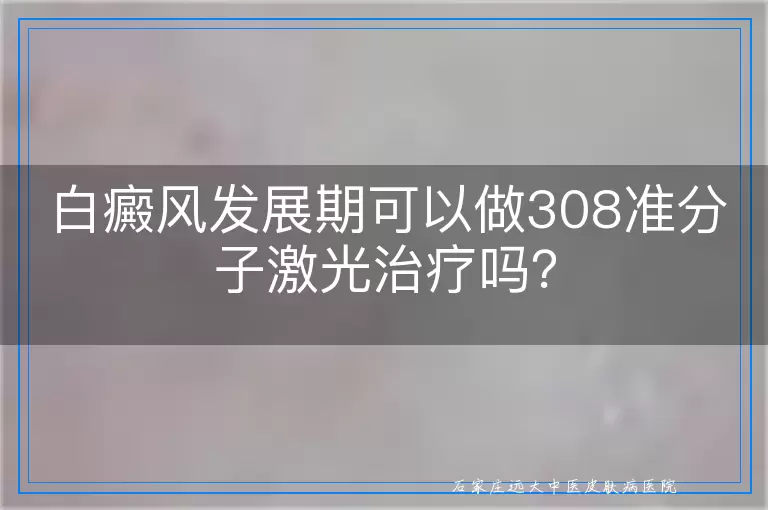 白癜风发展期可以做308准分子激光治疗吗？