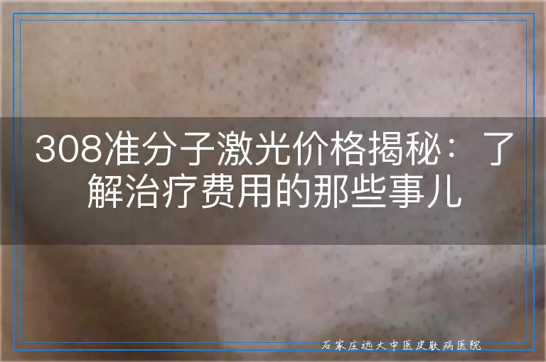 308准分子激光价格揭秘：了解治疗费用的那些事儿