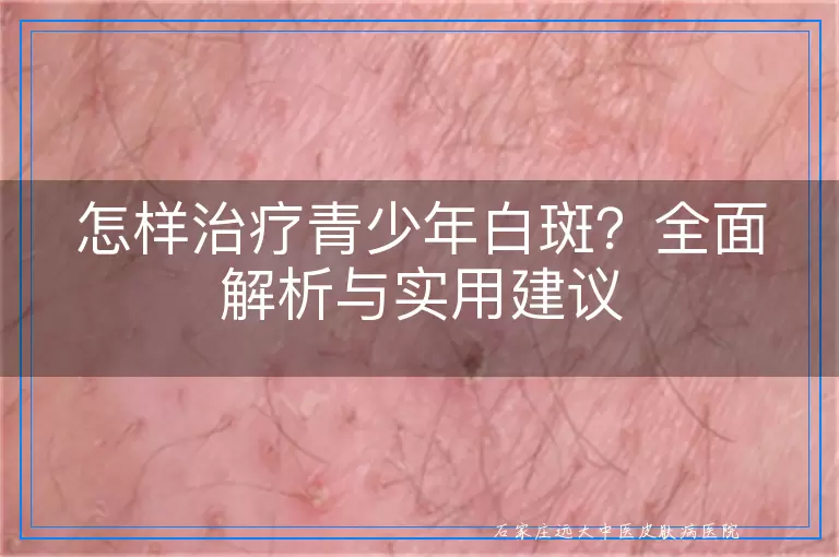 怎样治疗青少年白斑？全面解析与实用建议