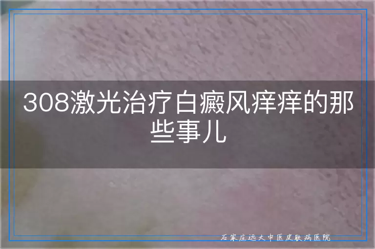 308激光治疗白癜风痒痒的那些事儿