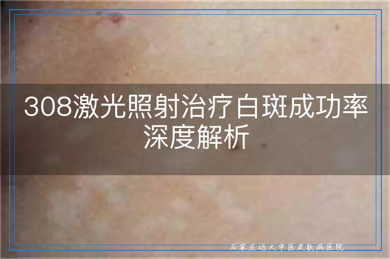 308激光照射治疗白斑成功率深度解析