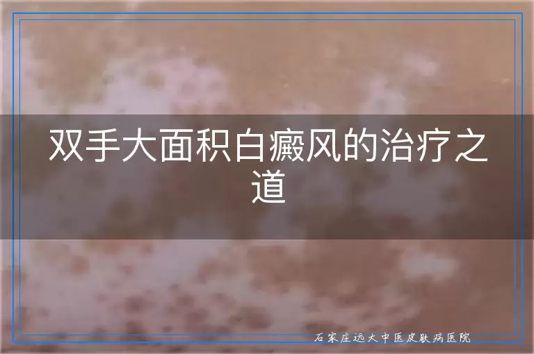 双手大面积白癜风的治疗之道