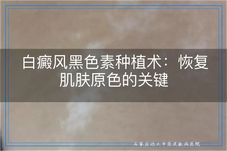 白癜风黑色素种植术：恢复肌肤原色的关键