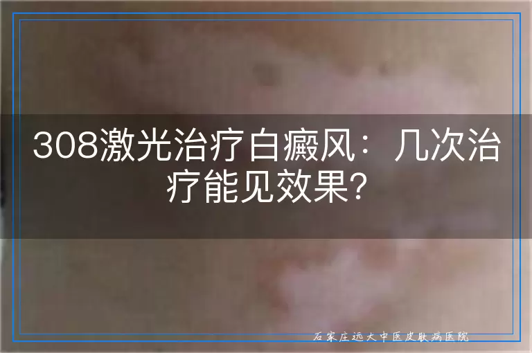 308激光治疗白癜风：几次治疗能见效果？
