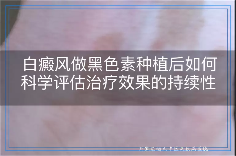 白癜风做黑色素种植后如何科学评估治疗效果的持续性