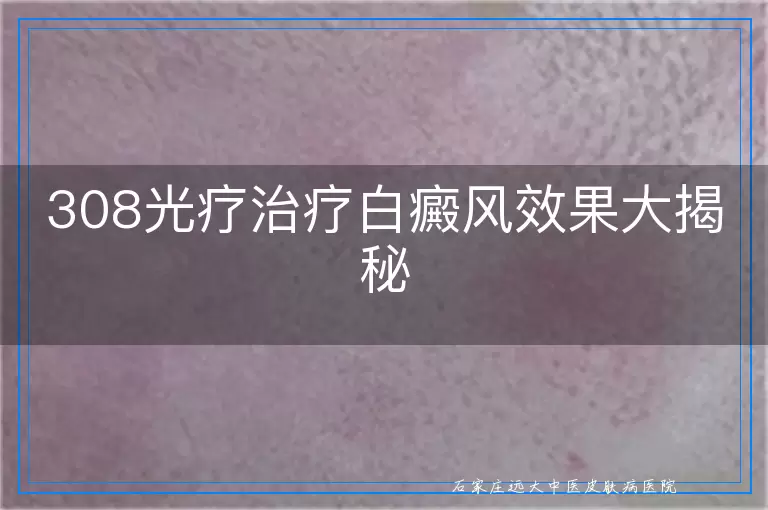 308光疗治疗白癜风效果大揭秘
