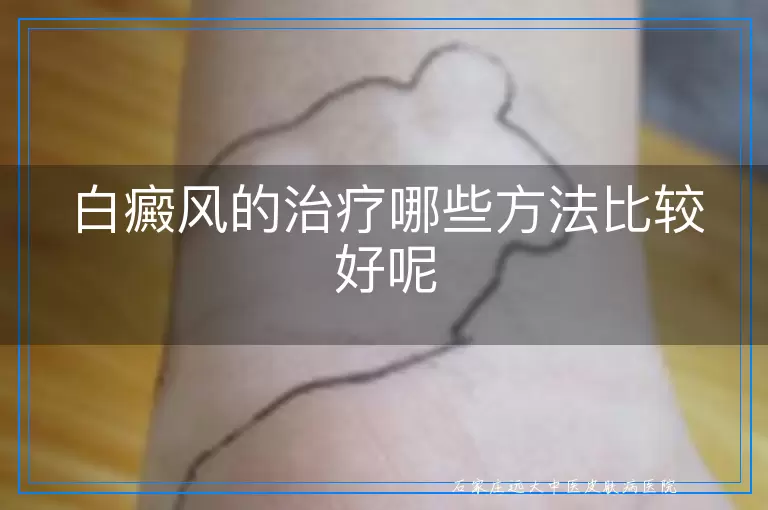 白癜风的治疗哪些方法比较好呢