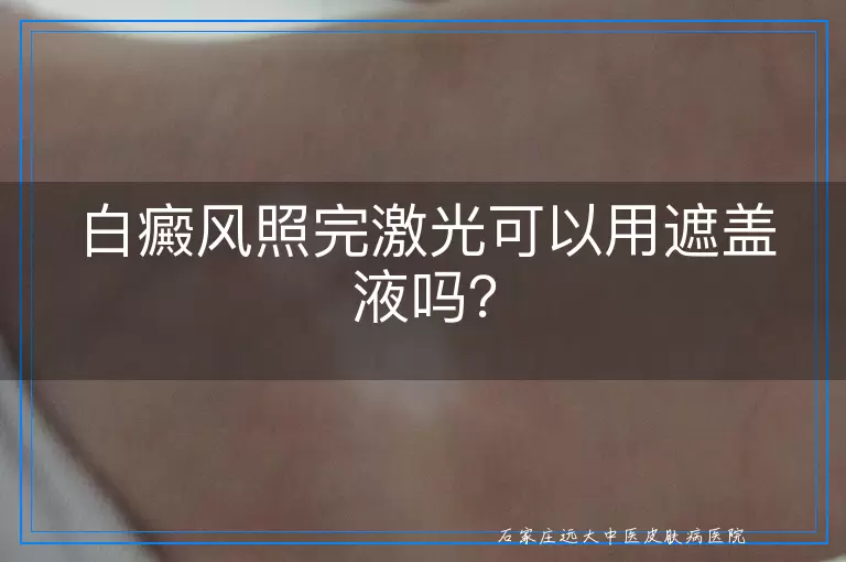 白癜风照完激光可以用遮盖液吗？