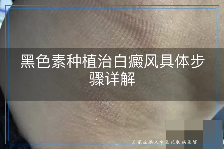 黑色素种植治白癜风具体步骤详解