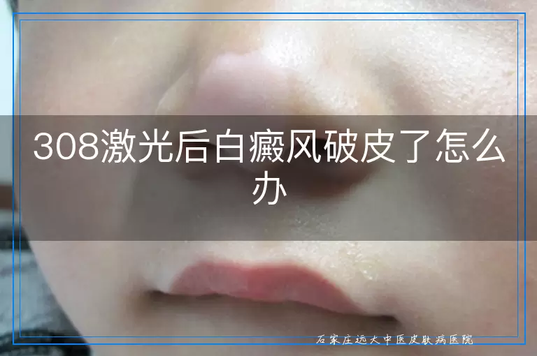 308激光后白癜风破皮了怎么办