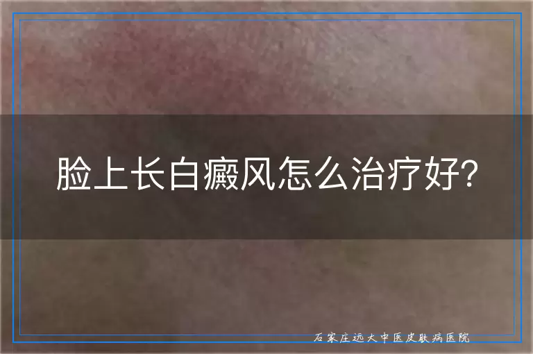 脸上长白癜风怎么治疗好？