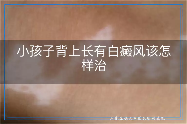 小孩子背上长有白癜风该怎样治