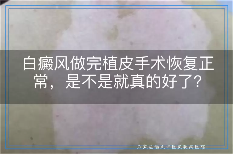 白癜风做完植皮手术恢复正常，是不是就真的好了？