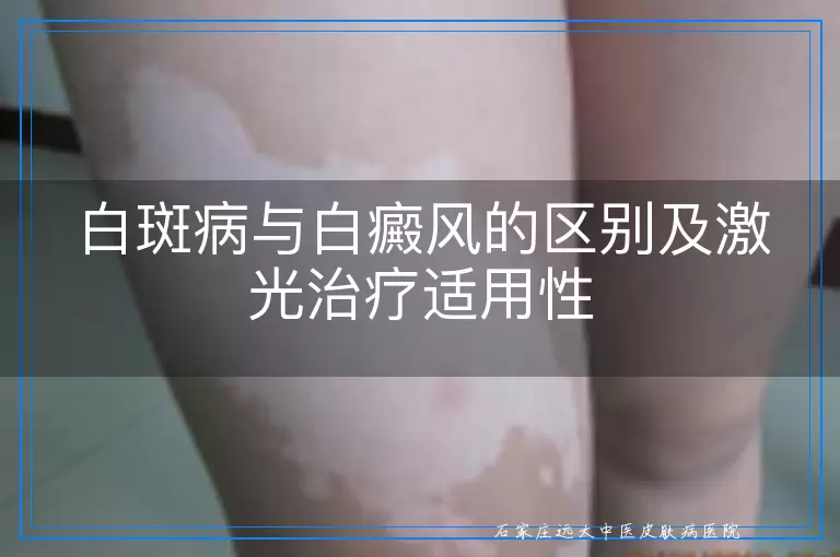 白斑病与白癜风的区别及激光治疗适用性