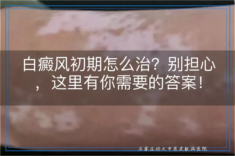 白癜风初期怎么治？别担心，这里有你需要的答案！