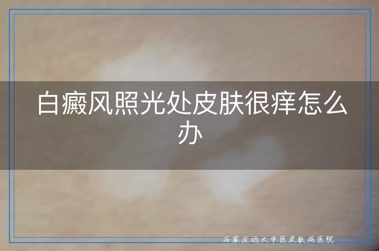 白癜风照光处皮肤很痒怎么办