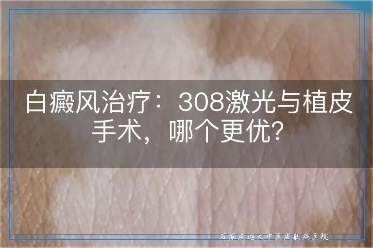 白癜风治疗：308激光与植皮手术，哪个更优？