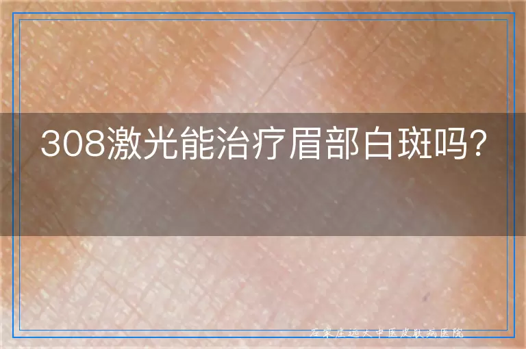 308激光能治疗眉部白斑吗？