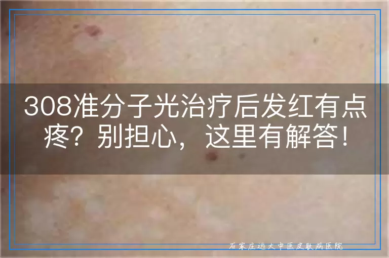 308准分子光治疗后发红有点疼？别担心，这里有解答！
