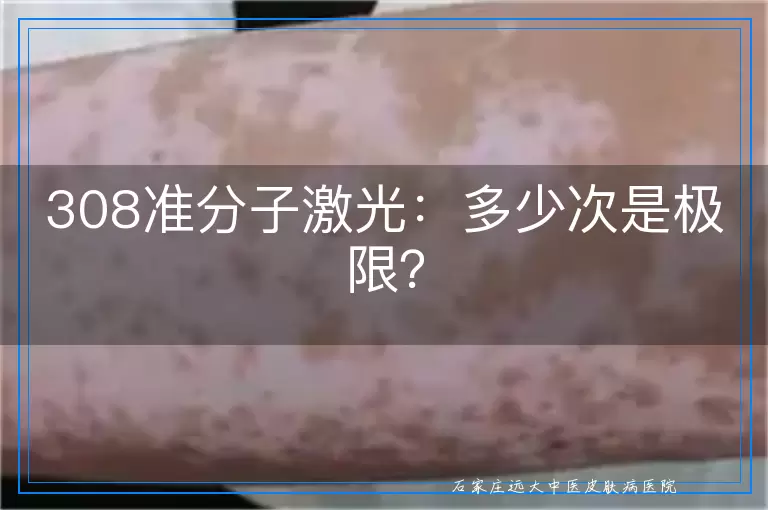 308准分子激光：多少次是极限？
