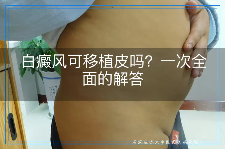 白癜风可移植皮吗？一次全面的解答
