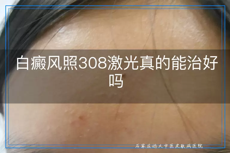 白癜风照308激光真的能治好吗