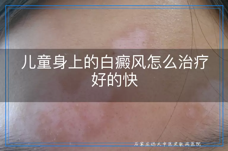 儿童身上的白癜风怎么治疗好的快