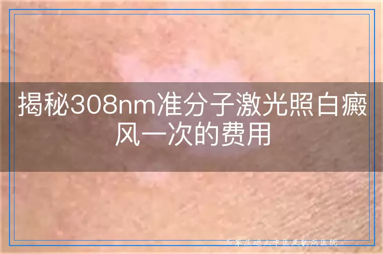 揭秘308nm准分子激光照白癜风一次的费用
