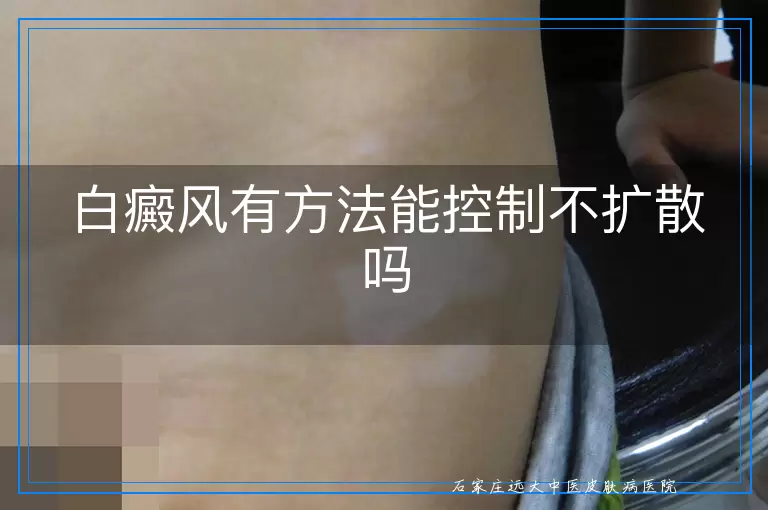 白癜风有方法能控制不扩散吗
