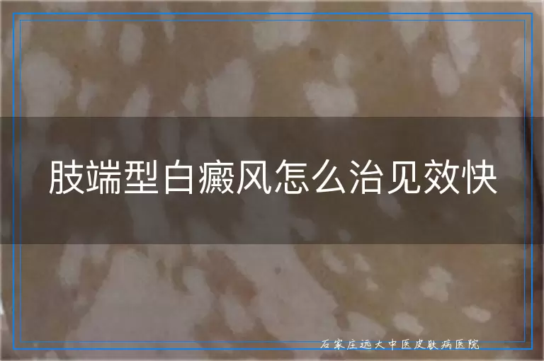 肢端型白癜风怎么治见效快