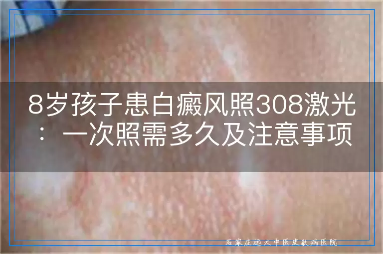 8岁孩子患白癜风照308激光：一次照需多久及注意事项