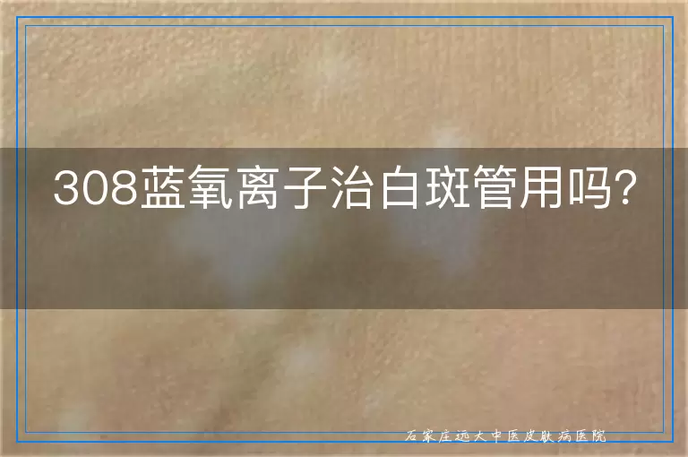 308蓝氧离子治白斑管用吗？