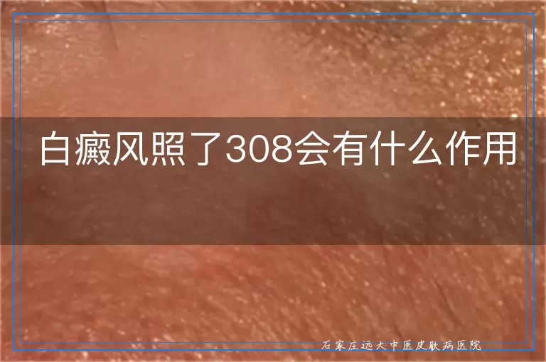 白癜风照了308会有什么作用