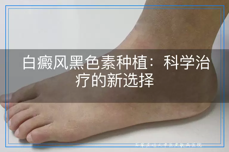 白癜风黑色素种植：科学治疗的新选择