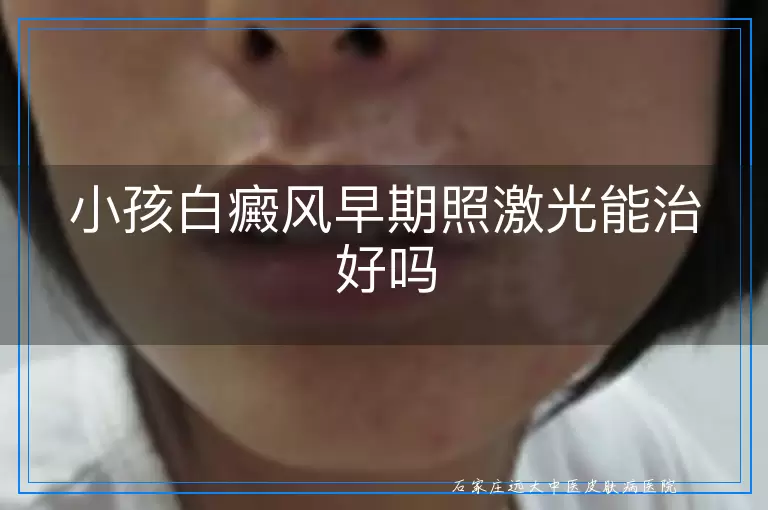 小孩白癜风早期照激光能治好吗